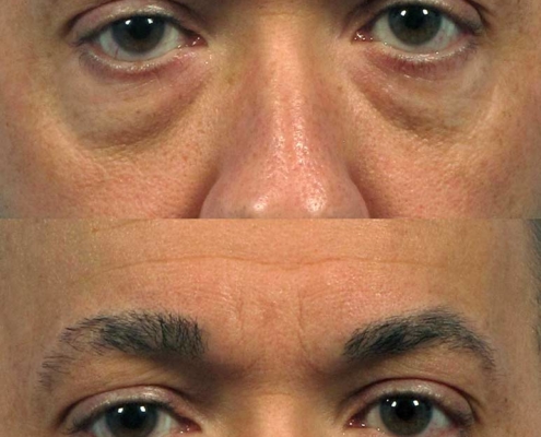 Effective, safe, and long-lasting Cannula under-eye filler