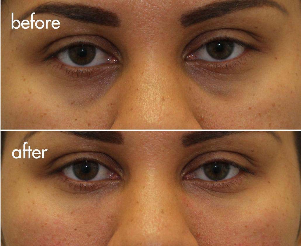 dark circles filler nyc