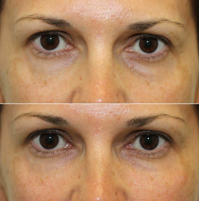 Dr. Kotlus undery-eye Cannula treatment remove years from your skin