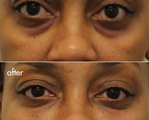 Dr. Kotlus Cannula Under Eye Treatment