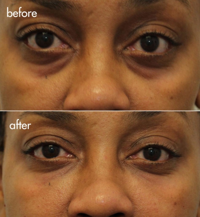 Dr. Kotlus Cannula Under Eye Treatment