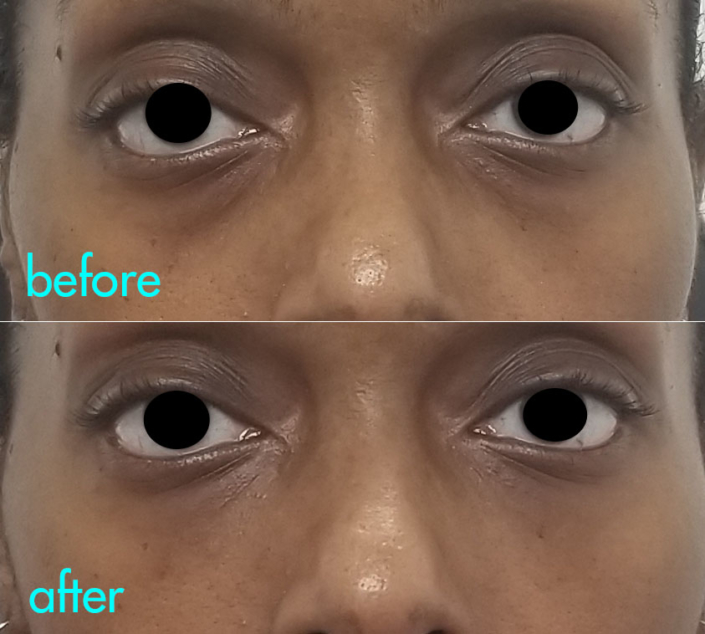 Dr. Kotlus eye filler nyc