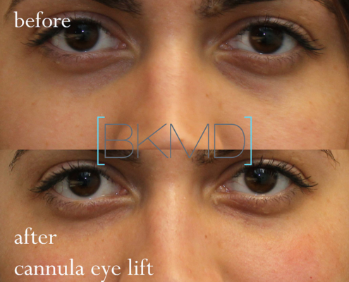 under eye filler nyc