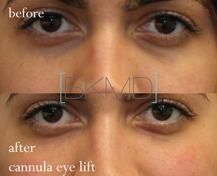 under eye filler nyc