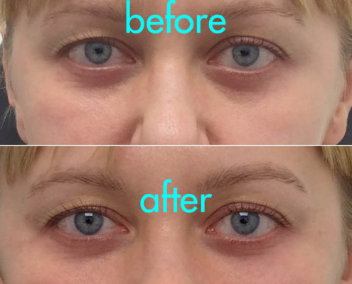 Cannula Under Eye Treatment