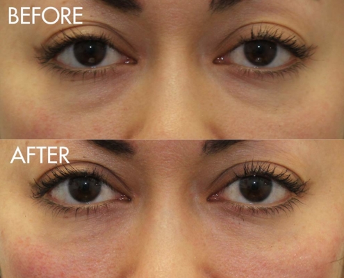 Before and after the Cannula under-eye filler procedure
