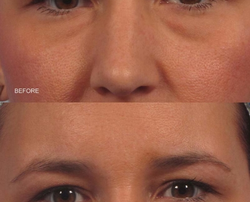 Dr. Kotlus Cannula Under Eye Filler