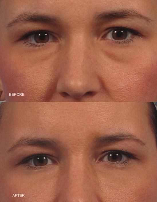 Dr. Kotlus Cannula Under Eye Filler