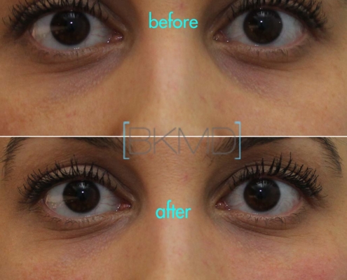 Before and After Cannula Eye Treatment by Dr. Kotlus