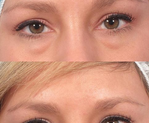 Reverse under eye bags with Dr. Kotlus' Cannual under-eye treatment