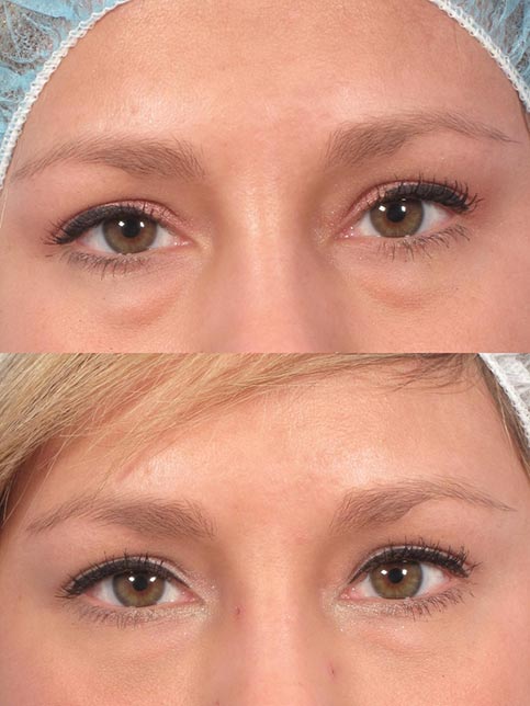 Hollow  Sunken Eye Filler Injections London  SAS Aesthetics