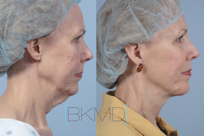 neck lift nyc laser