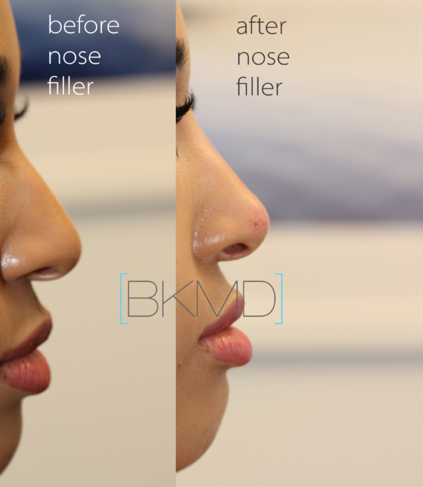 nyc nose filler