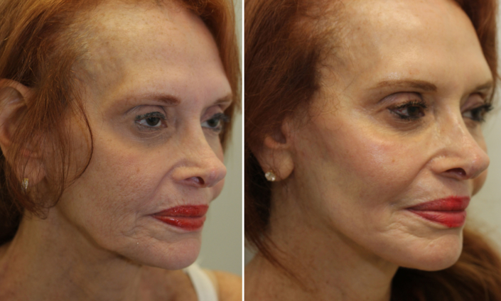 facelift laser nyc