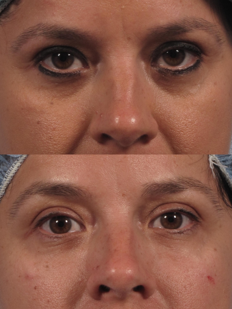 Double Eyelid Tape and Glue  Dr. Brett Kotlus, Cosmetic Oculoplastic  Surgeon, NYC