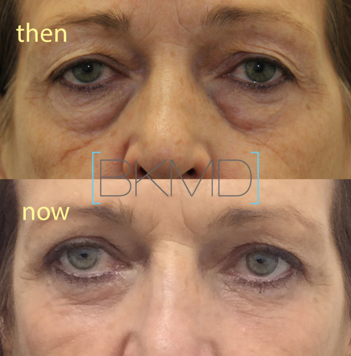 blepharoplasty nyc