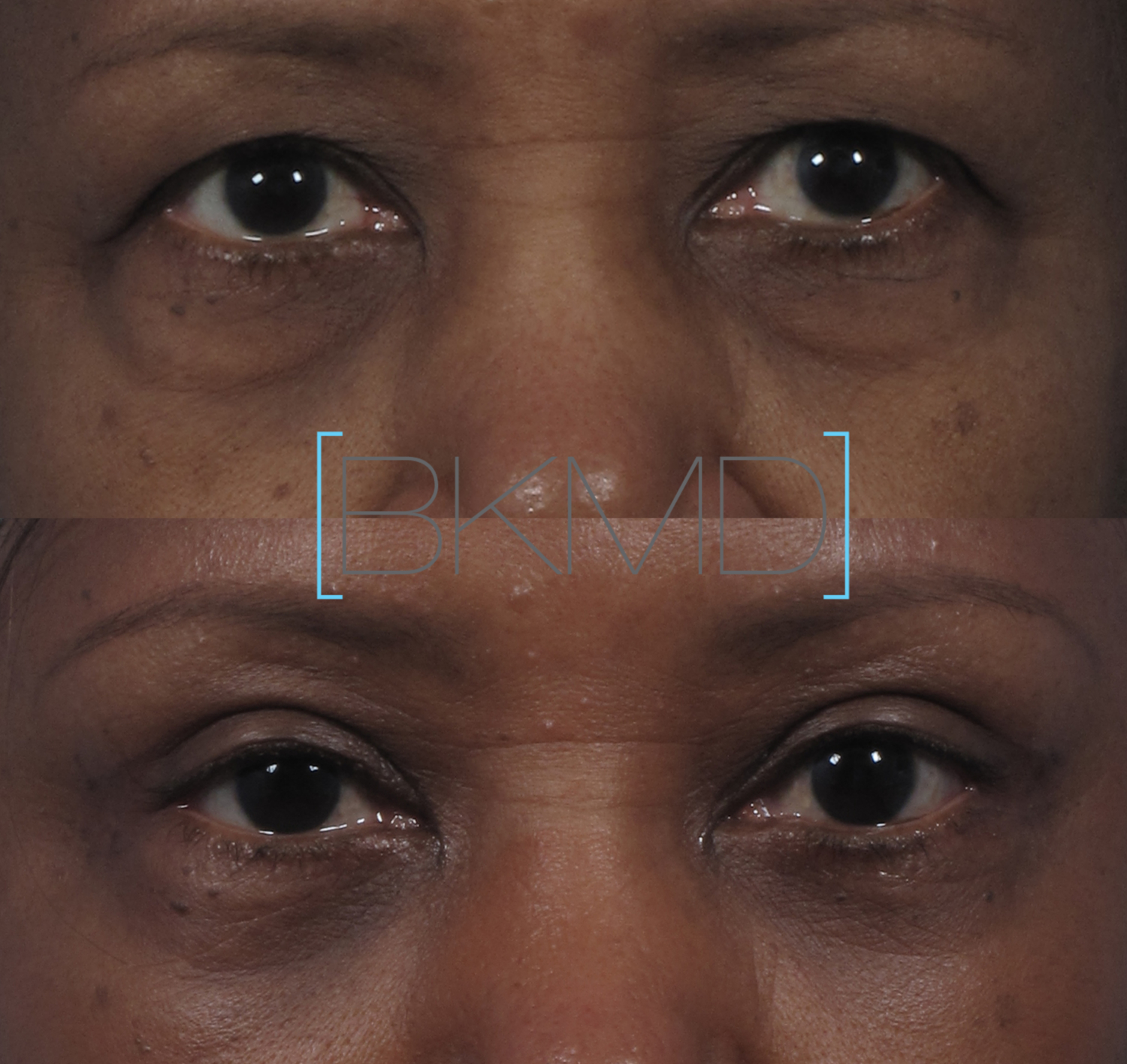 Lower Eyelid Lift (female) - Dr. Brett Kotlus
