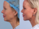 neck lift nyc