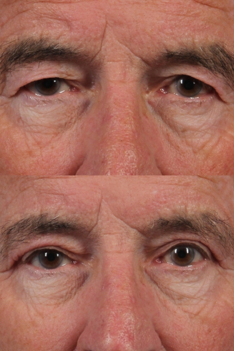 man upper eyelids nyc