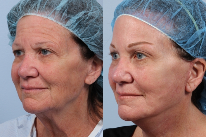 facelift with laser nyc