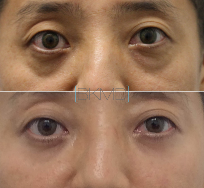 male lower eye lift nyc