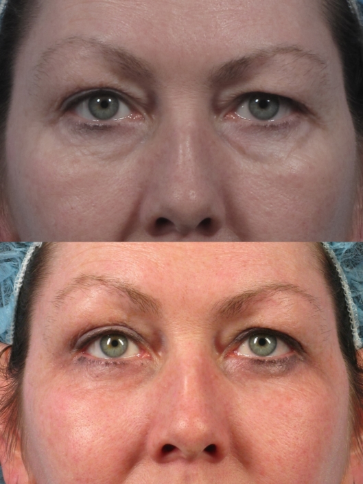 lower eye lift nyc