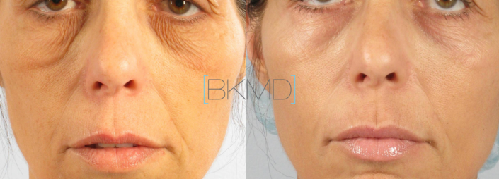 eyelid skin laser nyc