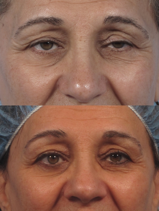 eyelid ptosis nyc