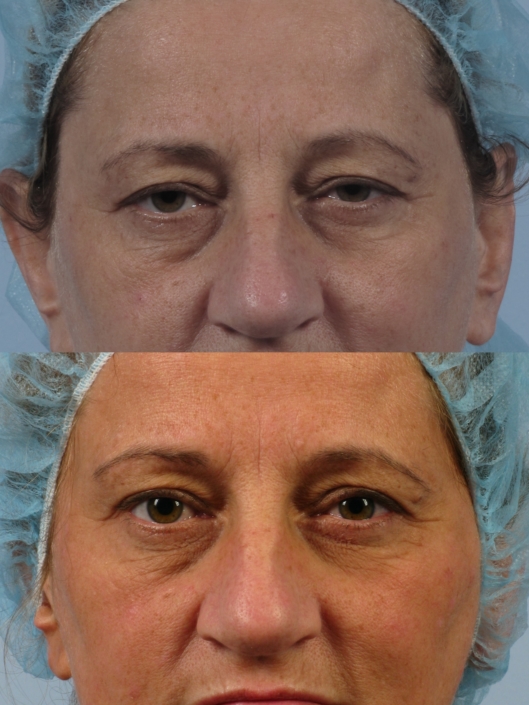 ptosis surgery nyc