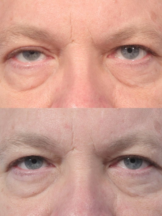 ptosis surgery nyc