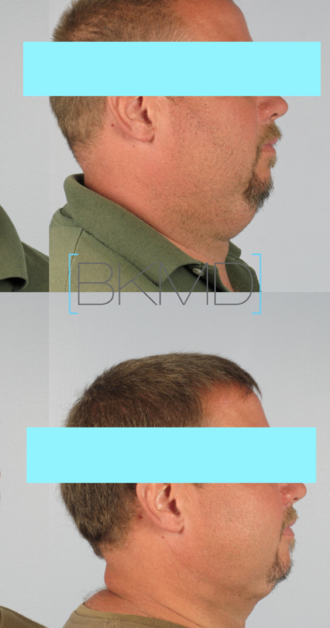 male neck lipo