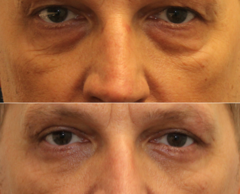 male blepharoplasty nyc