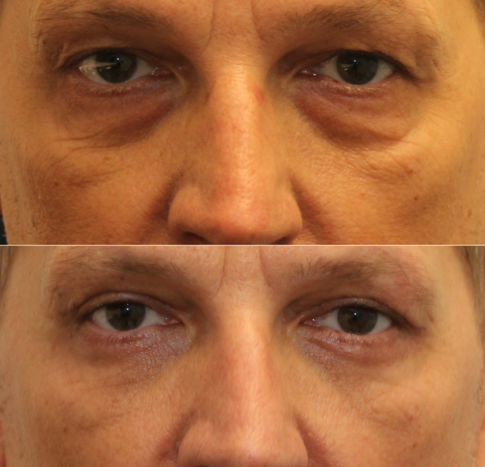 male blepharoplasty nyc